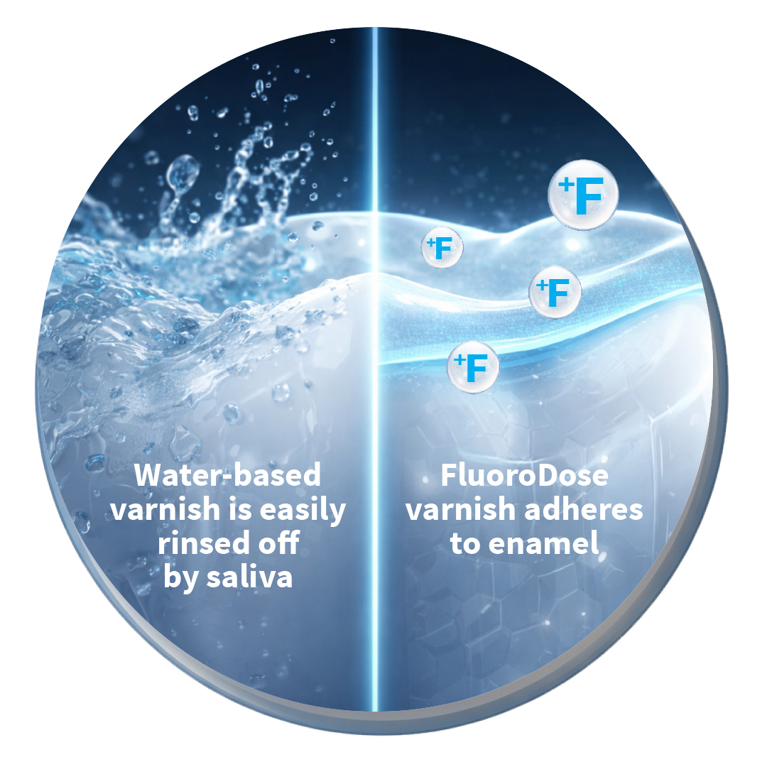 Fluoride varnish adheres to enamel while water-based varnish is easily rinsed off by saliva