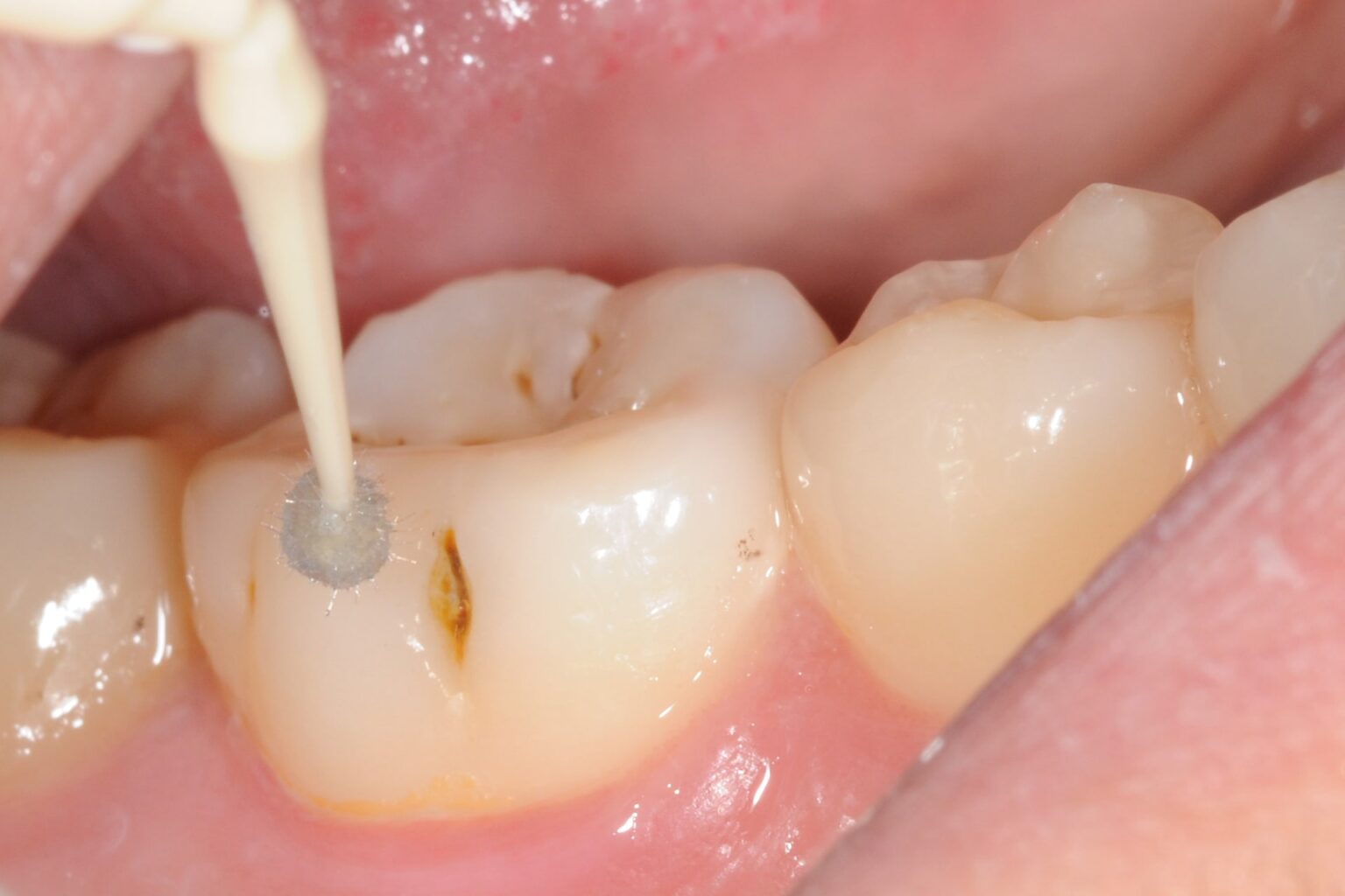 Silver Diamine Fluoride Clinical Cases - Centrix