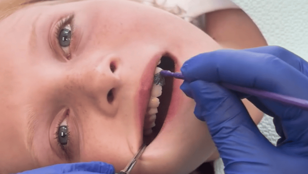 Combating Fluoride Hesitancy