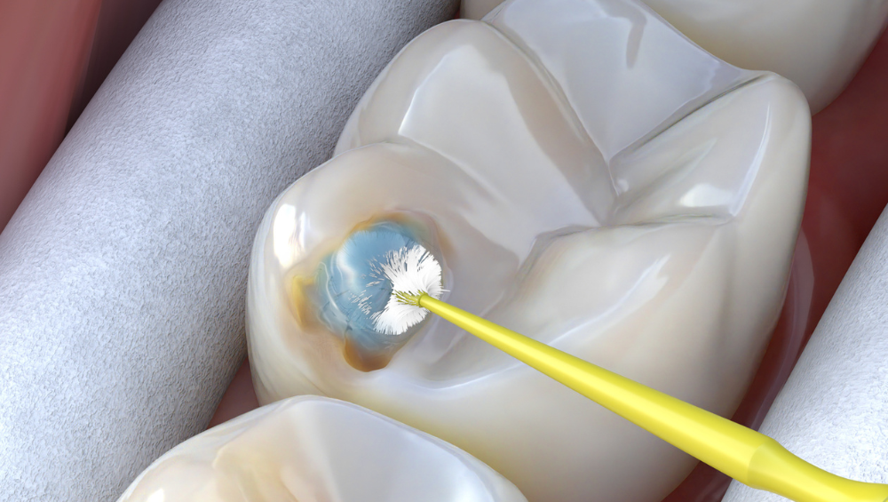 silver diamine fluoride being applied to tooth