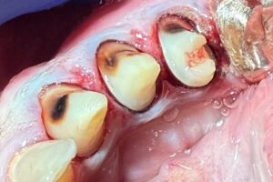 Tooth Prep