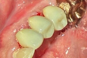 Crowns Placed Over SDF-Treated Teeth